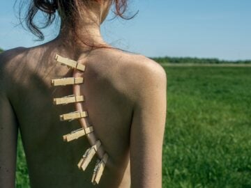 Clothespins attached to a bare back in a field.