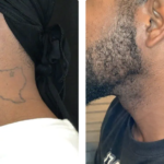 safe and effective tattoo remova