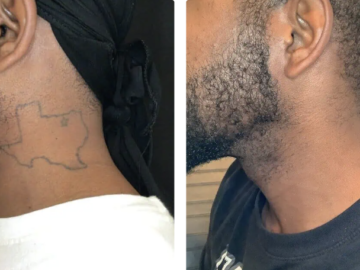 safe and effective tattoo remova