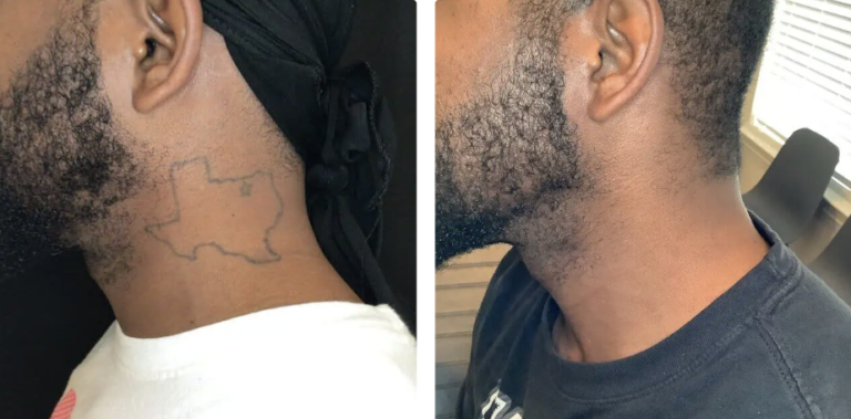 safe and effective tattoo remova